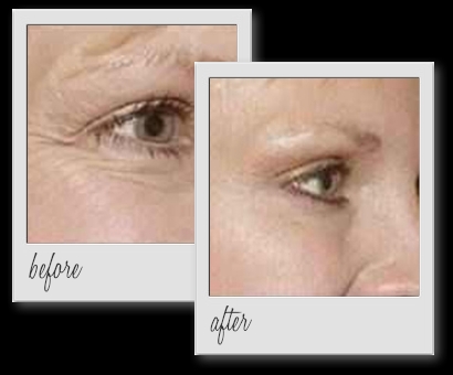 Wrinkle Relaxing Injections Crows Feet