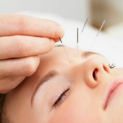 Cosmetic Acupuncture