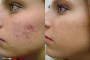 Elight acne treatment